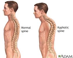 Kyphosis is a forward rounding of the back. Some rounding is normal, but.
