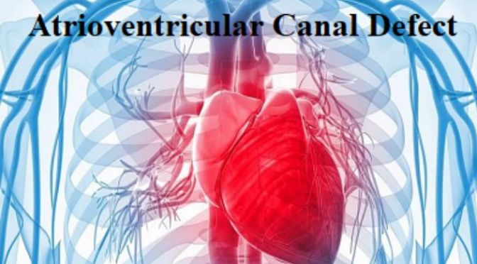 Atrioventricular canal defect (AVCD) or atrioventricular septal defect (AVSD) is a combination of heart problems resulting in a defect in the center of the heart.