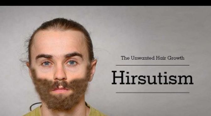 Hirsutism is excessive hair growth in certain areas of a woman’s face and body, such as the mustache and beard area, that creates a “male pattern” of hair.