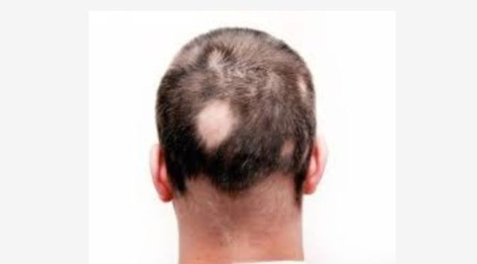 Alopecia areata, also known as spot baldness, is an autoimmune disease in which hair is lost from some or all areas of the body.